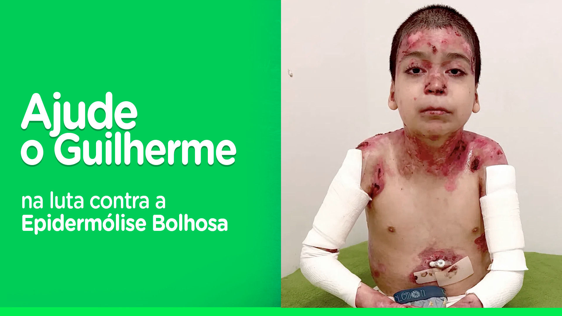 Ajude Guilherme no tratamento contra a Epidermólise Bolhosa